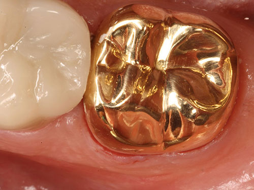 Gold Crown