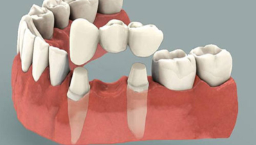 Dental Bridges