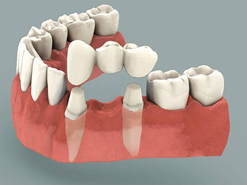 Dental Bridges