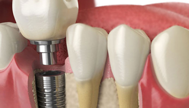 Implant Restoration