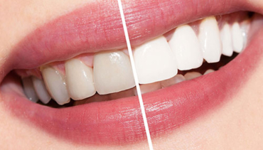 Teeth Whitening