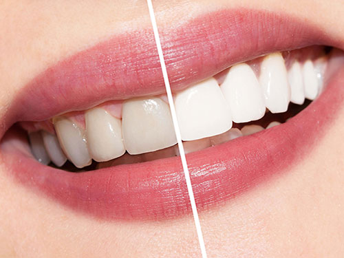 Teeth Whitening